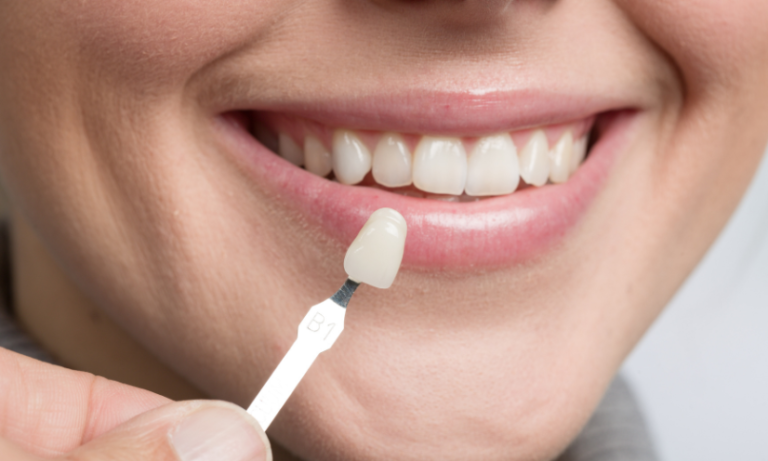 The Science Behind Dental Veneers and Smile Design 
